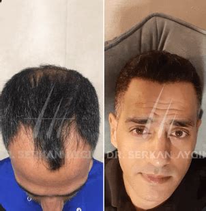 serkan aygin reviews|Serkan Aygin, MD Reviews, Before and After Photos, .